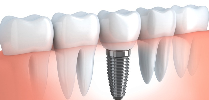 Ce sunt implanturile dentare?