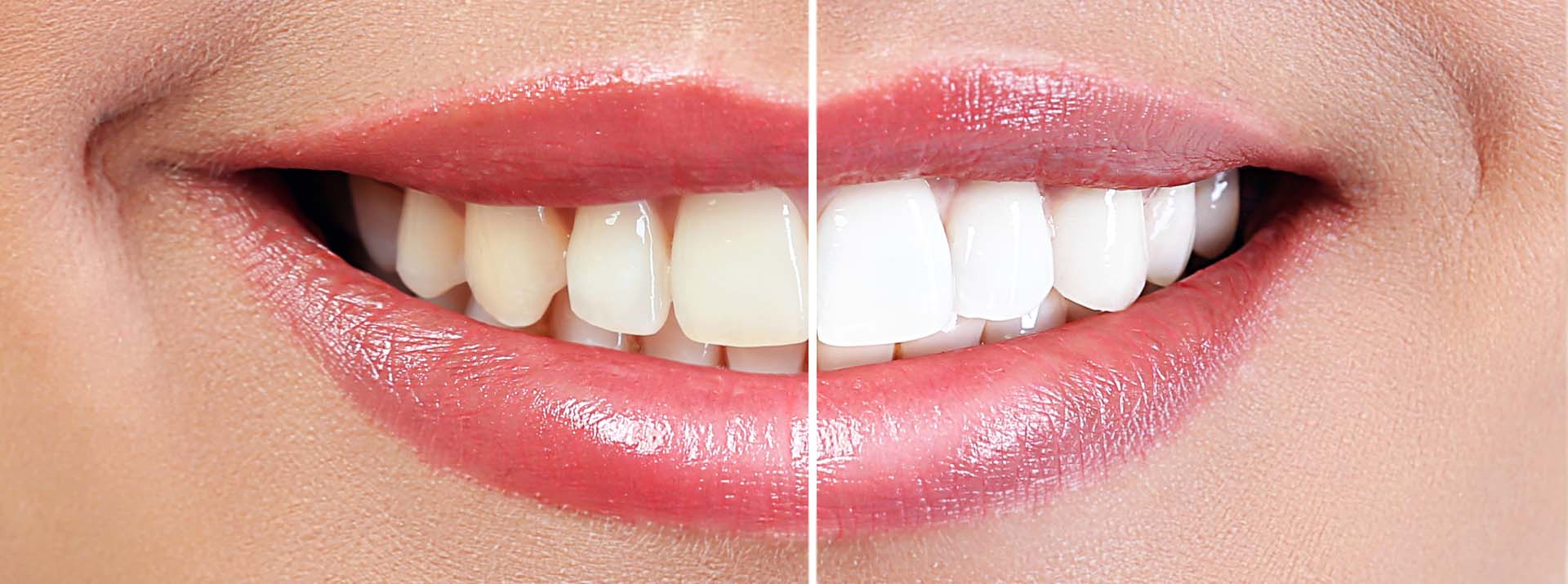 Ce este albirea dentara?