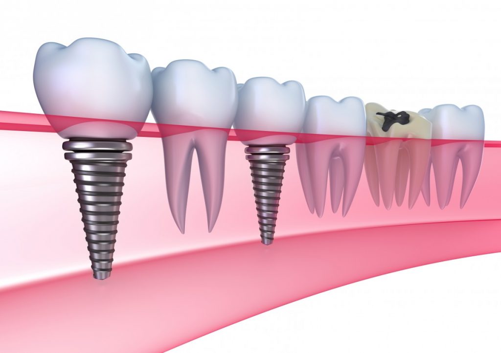 Ce sunt implanturile dentare?